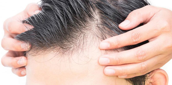 نشانه های طاس شدن آقایان
