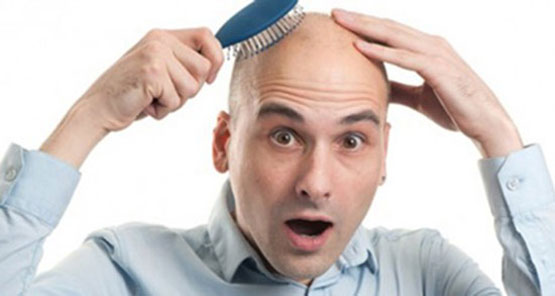 شجرنامه خانوادگی طاس شدن