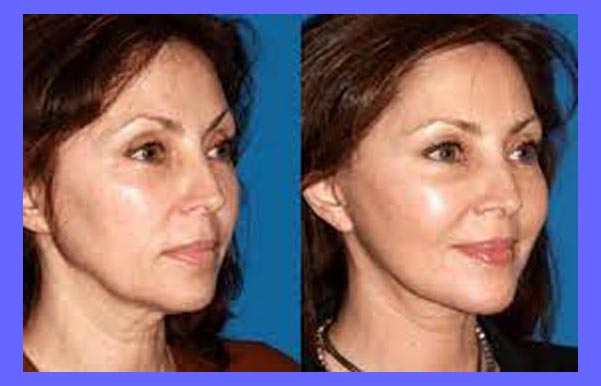 باورنکردنی از هزینه رفع چین و چروک زنان ایرانی