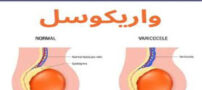واریکوسل چیست؟ علائم، علت، درمان با تغذیه