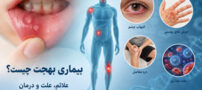 بیماری بهجت چیست؟ علائم، علت و درمان