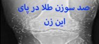 سوزن های طلا در پاهای زن کره ای!! + عکس