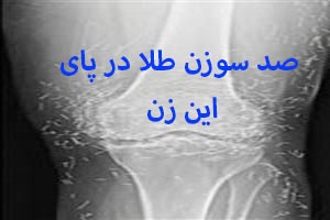 سوزن های طلا در پاهای زن کره ای!! + عکس سوزن های طلا در پاهای زن کره ای!! + عکس