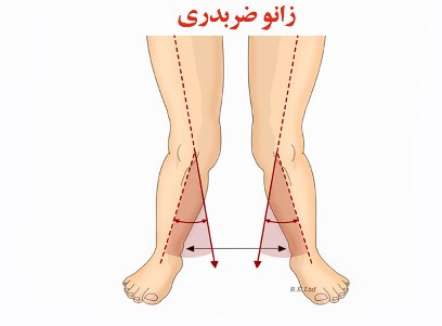 علل و عوارض زانوی ضربدری چیست علل و عوارض زانوی ضربدری چیست
