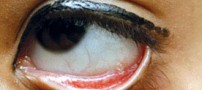چشم های عجیب و باورنکردنی دختر 10 ساله (عکس)