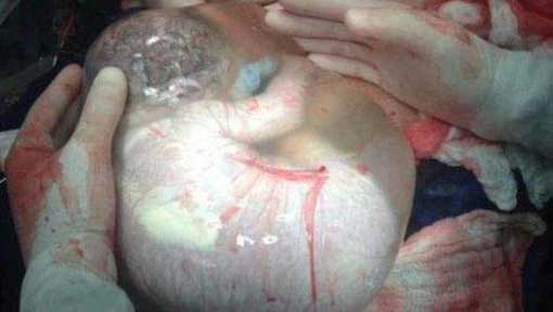 عکس دیده نشده از نوزاد در کیسه آب!
