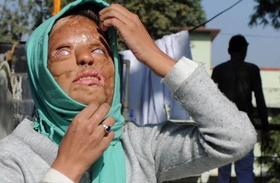 18+ عکس های از دختر قربانی اسید پاشی انتقامی