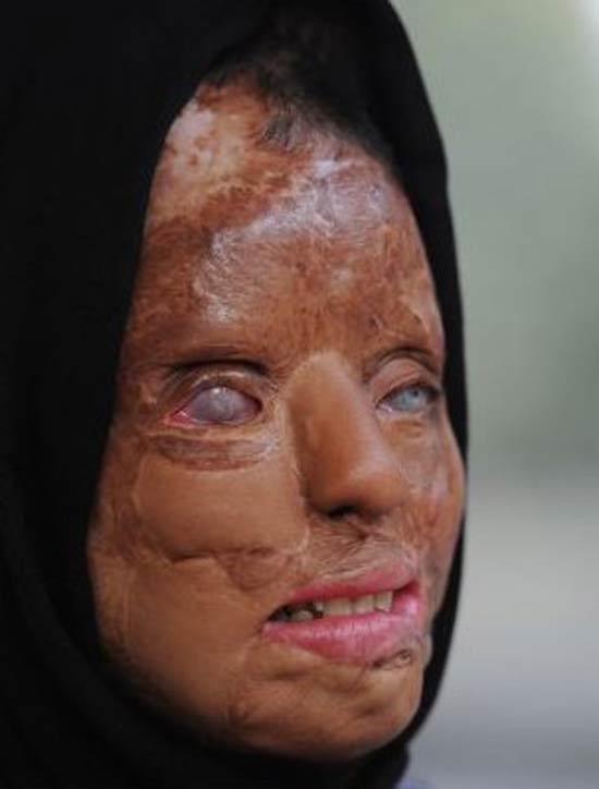 18+ عکس های از دختر قربانی اسید پاشی انتقامی