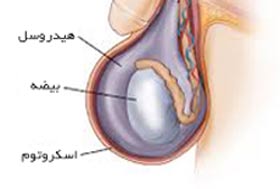 علل هیدروسل (آب آوردن بیضه) کدام است علل هیدروسل (آب آوردن بیضه) کدام است