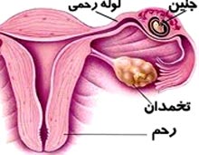 حاملگی خارج از رحم چه علائمی دارد حاملگی خارج از رحم چه علائمی دارد