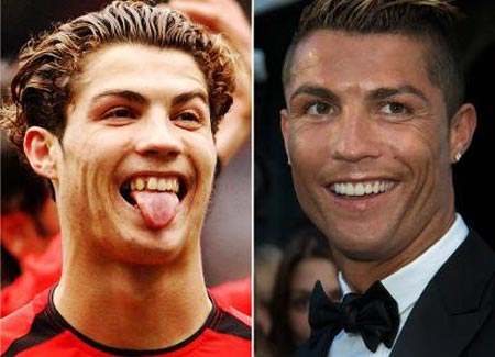 چهره کریس رونالدو قبل و بعد از ارتودنسی