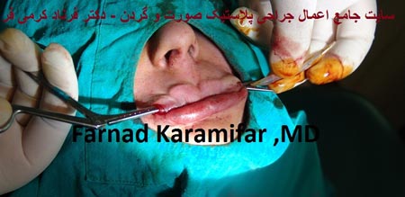 تصاویر عمل جراحی پروتز لب یک خانم (دلخراش 18+)