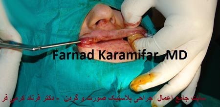 تصاویر عمل جراحی پروتز لب یک خانم (دلخراش 18+)