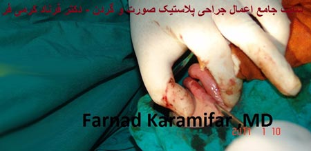 تصاویر عمل جراحی پروتز لب یک خانم (دلخراش 18+)