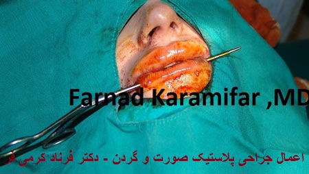 تصاویر عمل جراحی پروتز لب یک خانم (دلخراش 18+)