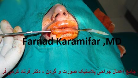 تصاویر عمل جراحی پروتز لب یک خانم (دلخراش 18+)