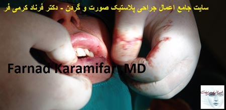 تصاویر عمل جراحی پروتز لب یک خانم (دلخراش 18+)