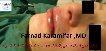تصاویر عمل جراحی پروتز لب یک خانم (دلخراش 18+)