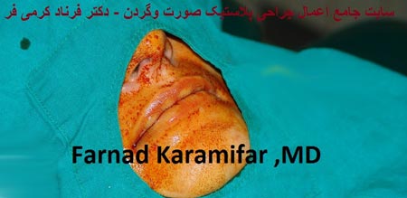 تصاویر عمل جراحی پروتز لب یک خانم (دلخراش 18+)