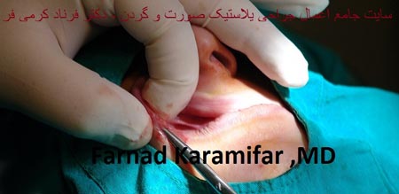 تصاویر عمل جراحی پروتز لب یک خانم (دلخراش 18+)
