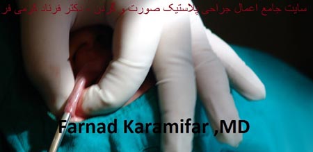 تصاویر عمل جراحی پروتز لب یک خانم (دلخراش 18+)