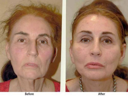 عکس های دیدنی از قبل و بعد از عمل فیس لیفتینگ عکس های دیدنی از قبل و بعد از عمل فیس لیفتینگ