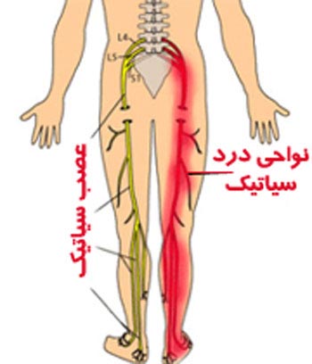 این نوع کمر درد نشانه ی ابتلا به سیاتیک است