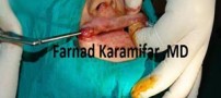 تصاویر عمل جراحی پروتز لب یک خانم (دلخراش 18+)