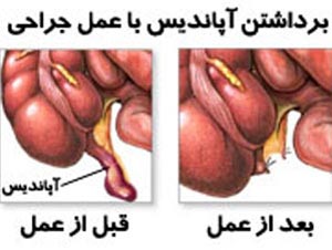 علت پاره شدن آپاندیس علت پاره شدن آپاندیس