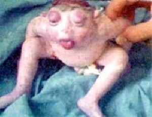 تولد کودکی عجیب به شکل قورباغه! + (عکس)