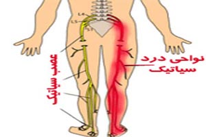 این نوع کمر درد نشانه ی ابتلا به سیاتیک است این نوع کمر درد نشانه ی ابتلا به سیاتیک است