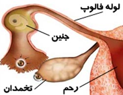 علائم بارداری خارج از رحم چیست علائم بارداری خارج از رحم چیست