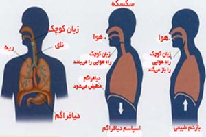 چرا سکسکه می کنیم و چه راه درمانی دارد؟ چرا سکسکه می کنیم و چه راه درمانی دارد؟