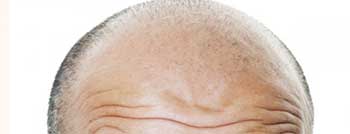 شایع ترین علل ریزش مو در آقایان و هم خانم ها شایع ترین علل ریزش مو در آقایان و هم خانم ها