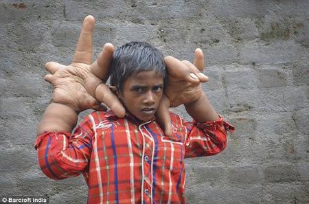 پسر 8 ساله و دست های غول پیکر او جهانی شد + عکس