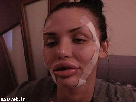 دختری که بطرز فجیع قربانی عمل زیبایی شد! عکس