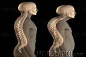 ورزش های مناسب برای رفع قوز