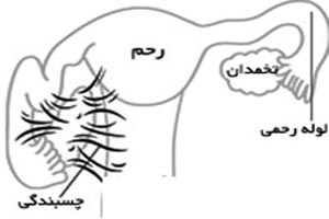 چسبندگی رحم چه عوارضی را به دنبال دارد چسبندگی رحم چه عوارضی را به دنبال دارد