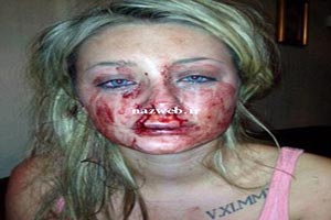 بوسه عاشقانه و خونین این پسر از دوست دخترش + تصاویر بوسه عاشقانه و خونین این پسر از دوست دخترش + تصاویر