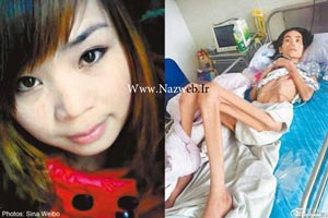 اندام فجیع و شوکه کننده دختر 26 ساله پوست و استخوان + تصاویر اندام فجیع و شوکه کننده دختر 26 ساله پوست و استخوان + تصاویر