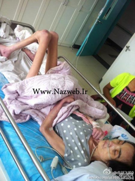 اندام فجیع و شوکه کننده دختر 26 ساله پوست و استخوان + تصاویر
