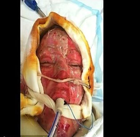 عکس های تکان دهنده از جراحی صورت سوخته یک زن