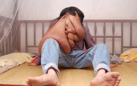 تصاویر دردناک از دومین مرد دنیا با صورتی آویزان 16+