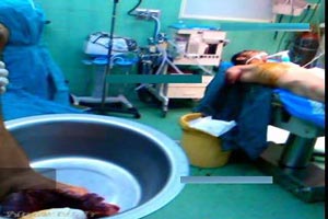 پیوند نادر قطع بازوی یک کارگر در تبریز + تصاویر 16+