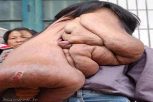 تصاویر دردناک از دومین مرد دنیا با صورتی آویزان 16+ تصاویر دردناک از دومین مرد دنیا با صورتی آویزان 16+