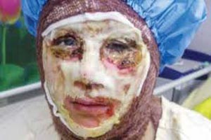 عیادت دستیار ویژه رئیس جمهوراز دختر قربانی اسید پاشی + عکس