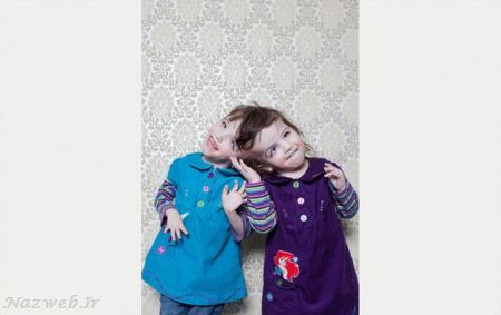 عکس های دیدنی دو خواهر دوقلو با یک مغز مشترک!! جلل الخالق