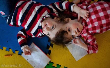 عکس های دیدنی دو خواهر دوقلو با یک مغز مشترک!! جلل الخالق