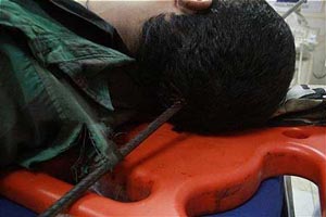 فرو رفتن وحشتناک میلگرد در سر کارگر جوان + تصاویر