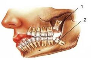 آنچه باید درباره دندان عقل بدانید